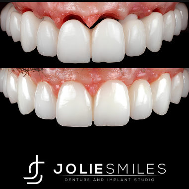 Porcelain Implant Bridge